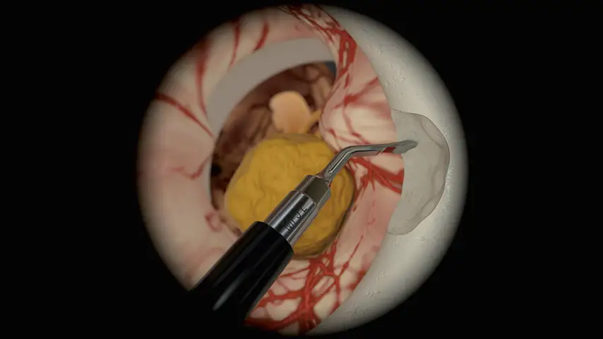 Acoustic nerve decompression
