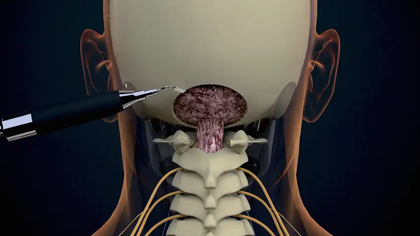 Chiari malformation