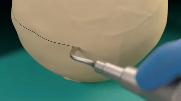 Micrometric cut for minimal bone loss