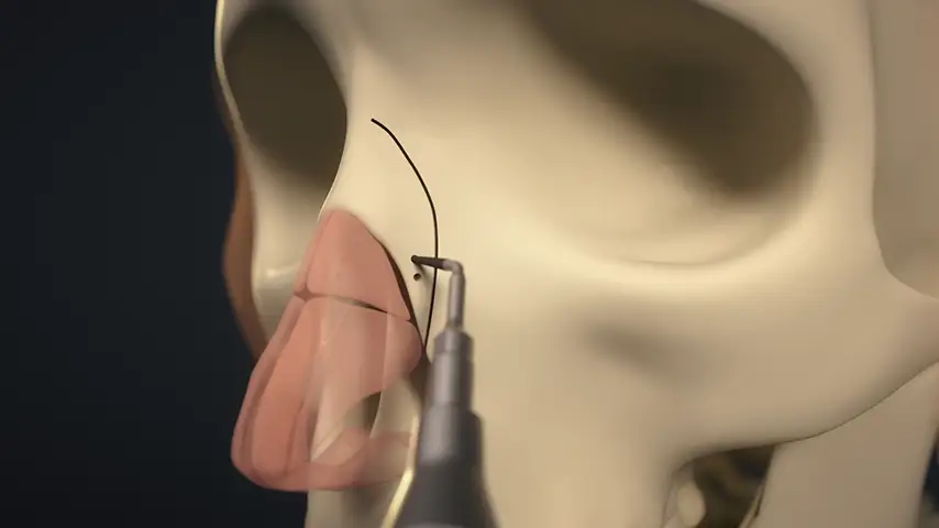 Drilling of septum for suture fixation