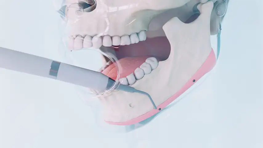 Jaw & chin feminization (JAWContour®)