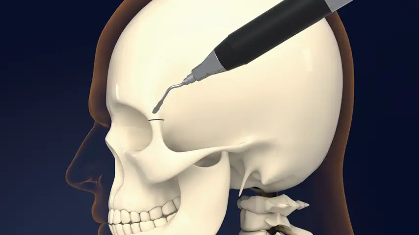 Osteotomies of orbital bones